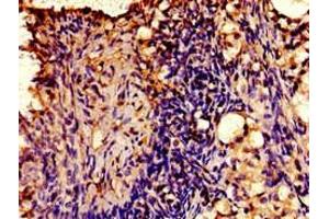 Immunohistochemistry of paraffin-embedded human ovarian cancer using ABIN7175412 at dilution of 1:100 (AVPR2 anticorps  (AA 221-271))