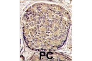 Formalin-fixed and paraffin-embedded human prostata carcinoma tissue reacted with PI3KCB antibody (C-term), which was peroxidase-conjugated to the secondary antibody, followed by DAB staining. (PI3KCB (AA 713-744), (C-Term) anticorps)
