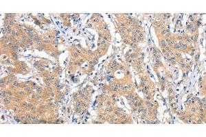Immunohistochemistry of paraffin-embedded Human gastric cancer tissue using ANKMY2 Polyclonal Antibody at dilution 1:30 (ANKMY2 anticorps)