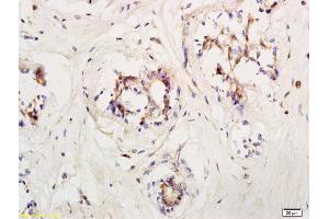 Formalin-fixed and paraffin embedded human breast carcinoma labeled with Anti LIFR/CD118 Polyclonal Antibody, Unconjugated (ABIN686827) at 1:200 followed by conjugation to the secondary antibody and DAB staining (LIFR anticorps  (AA 451-580))