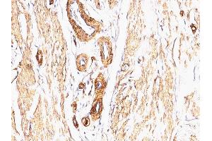 Formalin-fixed, paraffin-embedded human Leiomyosarcoma stained with Smooth Muscle Actin Mouse Monoclonal Antibody (SPM332). (Smooth Muscle Actin anticorps  (N-Term))