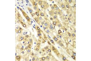 Immunohistochemistry of paraffin-embedded human liver cancer using CTBP1 antibody at dilution of 1:100 (400x lens). (CTBP1 anticorps)