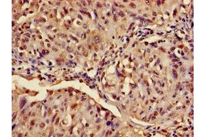 Immunohistochemistry of paraffin-embedded human lung cancer using ABIN7144793 at dilution of 1:100 (Ataxin 3 anticorps  (AA 1-288))