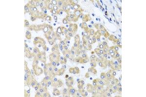 Immunohistochemistry of paraffin-embedded human liver injury using RAB24 antibody (ABIN5974578) at dilution of 1/100 (40x lens). (RAB24 anticorps)