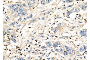 ABIN6260576 and ABIN6276962 at 1/100 staining Human gastric cancer by IHC-P. (CD151 anticorps  (N-Term))
