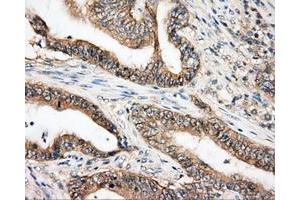 Immunohistochemical staining of paraffin-embedded Carcinoma of liver tissue using anti-BTK mouse monoclonal antibody. (BTK anticorps)
