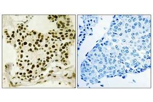 Immunohistochemistry analysis of paraffin-embedded human breast carcinoma tissue using UBF (Phospho-Ser484) antibody.