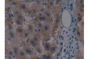 Detection of MAP3K1 in Human Liver cancer Tissue using Polyclonal Antibody to Mitogen Activated Protein Kinase Kinase Kinase 1 (MAP3K1)