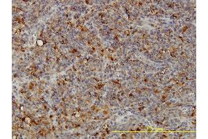 Immunoperoxidase of monoclonal antibody to ACP2 on formalin-fixed paraffin-embedded human lymphoma tissue.