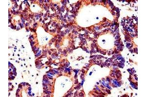 Immunohistochemistry of paraffin-embedded human colon cancer using ABIN7143200 at dilution of 1:100