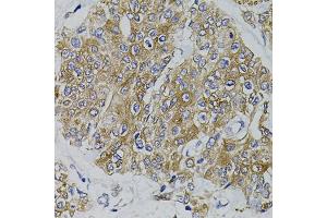 Immunohistochemistry of paraffin-embedded human prostate cancer using ARHGEF11 antibody (ABIN5995407) (40x lens). (ARHGEF11 anticorps)