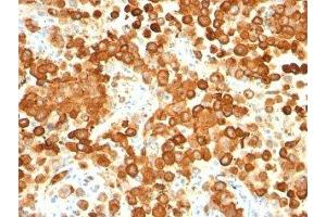Formalin-fixed, paraffin-embedded human melanoma stained with gp100 antibody (HMB45 + PMEL/783). (Melanoma gp100 anticorps)