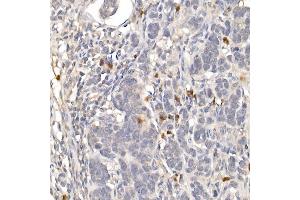 Immunohistochemistry of paraffin-embedded human colon carcinoma using NUR77 Rabbit pAb (ABIN6132395, ABIN6144826, ABIN6144829 and ABIN6222380) at dilution of 1:100 (40x lens).