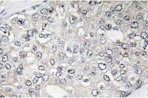 Immunohistochemistry (IHC) analyzes of p-p70 S6 kinase alpha antibody in paraffin-embedded human breast carcinoma tissue. (RPS6KB1 anticorps  (pThr444))