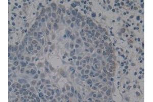 Detection of HMGB1 in Human Skin cancer Tissue using Polyclonal Antibody to High Mobility Group Protein 1 (HMGB1) (HMGB1 anticorps  (AA 9-163))