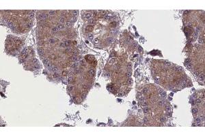 ABIN6272763 at 1/100 staining Human liver cancer tissue by IHC-P. (OR52N5 anticorps  (C-Term))