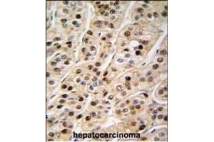 Formalin-fixed and paraffin-embedded human hepatocarcinoma tissue reacted with PCNA antibody (C-term) (ABIN389344 and ABIN2839453) , which was peroxidase-conjugated to the secondary antibody, followed by DAB staining. (PCNA anticorps  (C-Term))