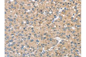 The image on the left is immunohistochemistry of paraffin-embedded Human liver cancer tissue using ABIN7192685(STK32C Antibody) at dilution 1/20, on the right is treated with synthetic peptide. (STK32C anticorps)