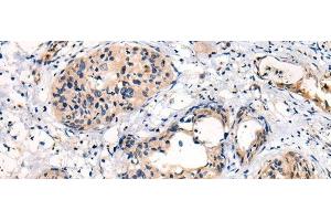Immunohistochemistry of paraffin-embedded Human cervical cancer tissue using C16orf45 Polyclonal Antibody at dilution of 1:45(x200) (C16orf45 anticorps)
