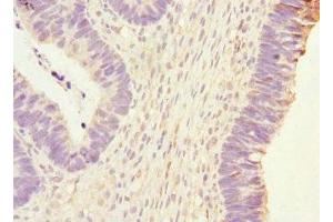 Immunohistochemistry of paraffin-embedded human ovarian cancer using ABIN7163403 at dilution of 1:100 (PHKG2 anticorps  (AA 237-406))
