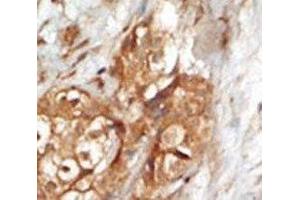 IHC analysis of FFPE human breast carcinoma tissue stained with the NIK antibody (MAP3K14 anticorps  (AA 119-148))
