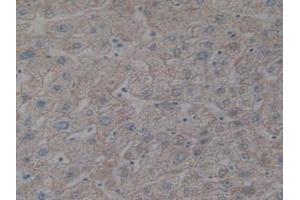 Detection of IkBb in Human Prostate Gland Cancer Tissue using Polyclonal Antibody to Inhibitory Subunit Of NF Kappa B Beta (IkBb)