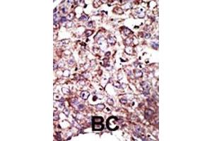 Formalin-fixed and paraffin-embedded human cancer tissue reacted with the primary antibody, which was peroxidase-conjugated to the secondary antibody, followed by DAB staining.