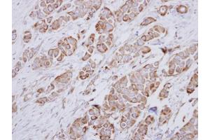 IHC-P Image Immunohistochemical analysis of paraffin-embedded human breast cancer, using NDUFA10, antibody at 1:250 dilution.