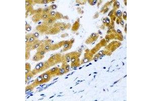 Immunohistochemical analysis of GPD2 staining in human liver cancer formalin fixed paraffin embedded tissue section. (GPD2 anticorps)