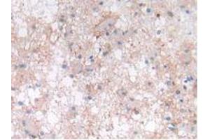 IHC-P analysis of Human Glioma Tissue, with DAB staining. (LIF anticorps  (AA 2-201))