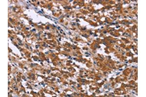 The image on the left is immunohistochemistry of paraffin-embedded Human thyroid cancer tissue using ABIN7192381(SKI Antibody) at dilution 1/40, on the right is treated with synthetic peptide. (SKI anticorps)
