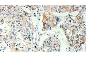 Immunohistochemistry of paraffin-embedded Human lung cancer tissue using TRPA1 Polyclonal Antibody at dilution 1:60 (TRPA1 anticorps)