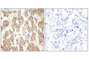 Immunohistochemistry analysis of paraffin-embedded human liver carcinoma tissue, using BAX antibody.