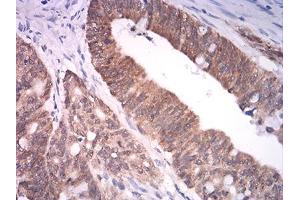 Immunohistochemical analysis of paraffin-embedded rectum cancer tissues using ASH2L mouse mAb with DAB staining. (ASH2L anticorps  (AA 493-628))