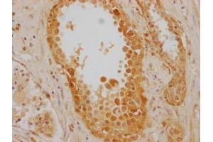 IHC image of ABIN7154884 diluted at 1:220 and staining in paraffin-embedded human prostate cancer performed on a Leica BondTM system.