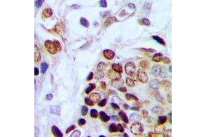Immunohistochemical analysis of TAF15 staining in human prostate cancer formalin fixed paraffin embedded tissue section.