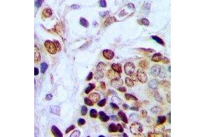 Immunohistochemical analysis of TAF15 staining in human prostate cancer formalin fixed paraffin embedded tissue section. (TAF15 anticorps)