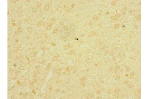 Immunohistochemistry of paraffin-embedded human glioma using ABIN7158206 at dilution of 1:100 (Lrig1 anticorps  (AA 35-220))