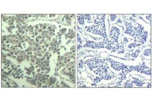 Immunohistochemical analysis of paraffin-embedded human breast carcinoma tissue using c-kit(Phospho-Tyr936) Antibody(left) or the same antibody preincubated with blocking peptide(right). (KIT anticorps  (pTyr936))