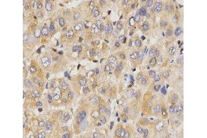 Immunohistochemistry of paraffin-embedded Human liver cancer using Eif2ak2 Polyclonal Antibody at dilution of 1:200 (40x lens). (EIF2AK2 anticorps)