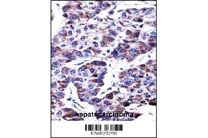 DUSP9 Antibody immunohistochemistry analysis in formalin fixed and paraffin embedded human hepatocarcinoma followed by peroxidase conjugation of the secondary antibody and DAB staining.