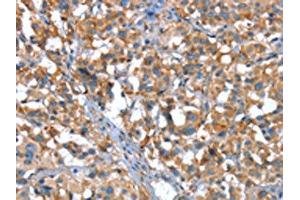 The image on the left is immunohistochemistry of paraffin-embedded Human thyroid cancer tissue using ABIN7190040(CACNA1G Antibody) at dilution 1/20, on the right is treated with synthetic peptide. (CACNA1G anticorps)