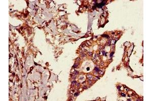 Immunohistochemistry of paraffin-embedded human pancreatic cancer using ABIN7174362 at dilution of 1:100 (CYLD anticorps  (C-Term))