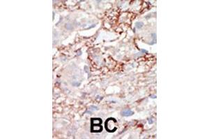 Formalin-fixed and paraffin-embedded human cancer tissue reacted with the primary antibody, which was peroxidase-conjugated to the secondary antibody, followed by AEC staining.