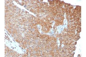 Formalin-fixed, paraffin-embedded human Urothelial Carcinoma stained with PAI-RBP1 Mouse Monoclonal Antibody (SERBP1/3493). (SERBP1 anticorps  (AA 3-139))