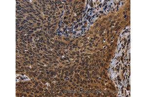 Immunohistochemistry of Human colon cancer using FHL3 Polyclonal Antibody at dilution of 1:40 (FHL3 anticorps)