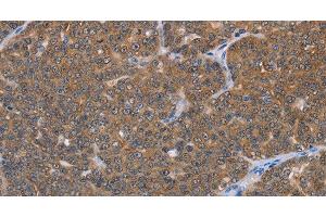 Immunohistochemistry of paraffin-embedded Human ovarian cancer using FABP6 Polyclonal Antibody at dilution of 1:30 (FABP6 anticorps)