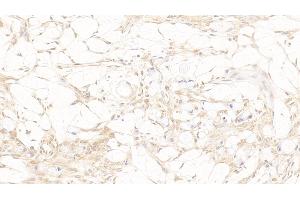 Detection of TDP43 in Human Ovarian cancer Tissue using Polyclonal Antibody to Tar DNA Binding Protein 43 kDa (TDP43)