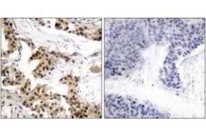 Immunohistochemistry analysis of paraffin-embedded human breast carcinoma, using NF-kappaB p105/p50 (Phospho-Ser893) Antibody. (NFKB1 anticorps  (pSer893))