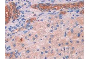 DAB staining on IHC-P; Samples: Human Liver cancer Tissue